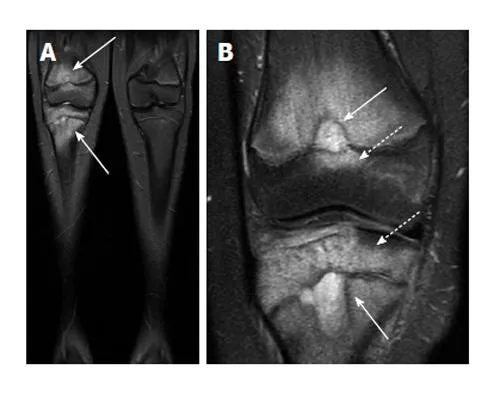 Subchondral bone marrow lesion MRI