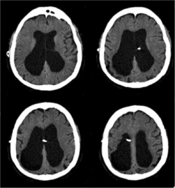 Figure 1: CT brain showing generalised cerebral atrophy with enlarged ventricles and widened sulci