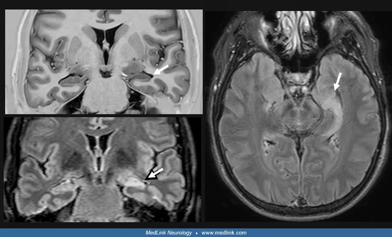 Figure 2: MRI brain T2 showing bilateral hippocampal atrophy in Alzheimer's disease