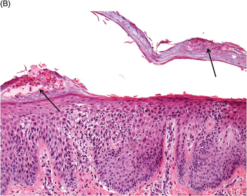 Histological comparison of eczematous dermatitis versus psoriasis showing key differentiating features