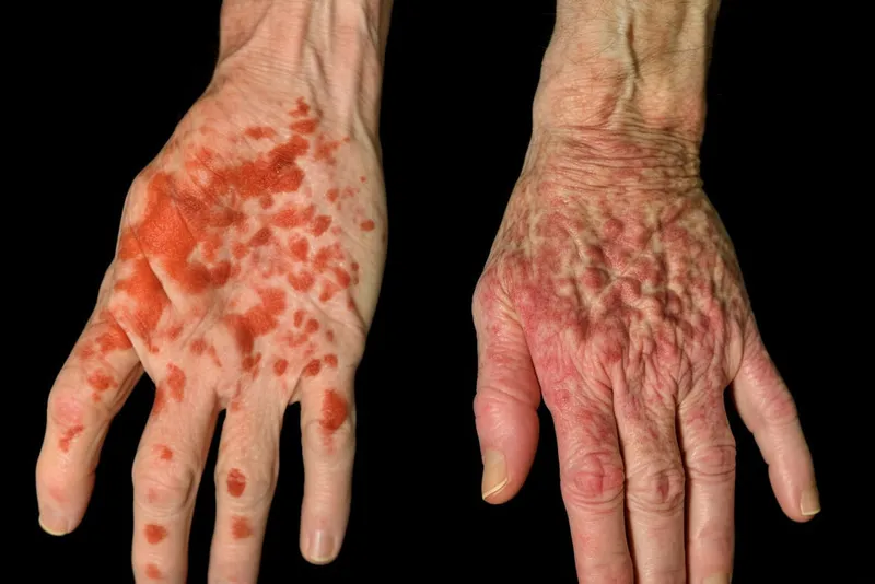 Clinical comparison showing psoriatic plaques versus eczematous patches with border characteristics