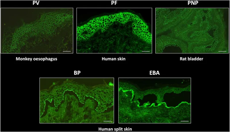 Direct immunofluorescence patterns in autoimmune blistering diseases