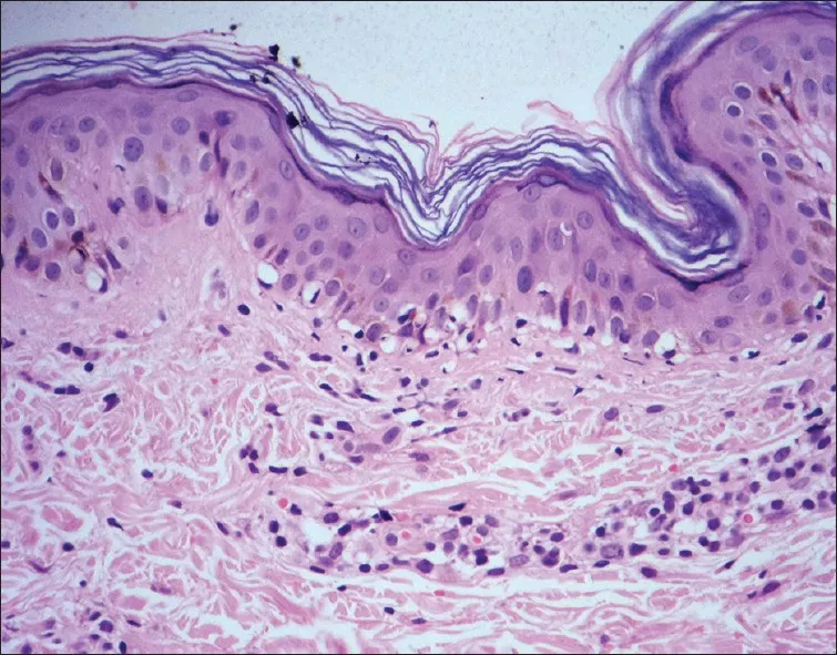 Microscopic view of interface dermatitis showing basal cell damage and lymphocytic infiltrate