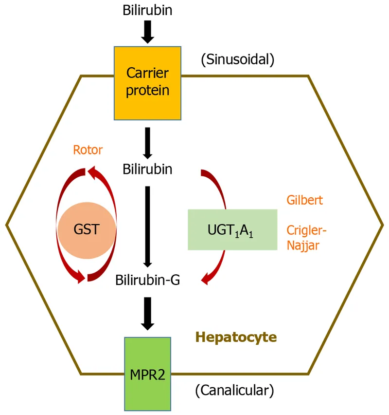 Bilirubin metabolism pathway showing UGT1A1 deficiency effects in Gilbert's syndrome