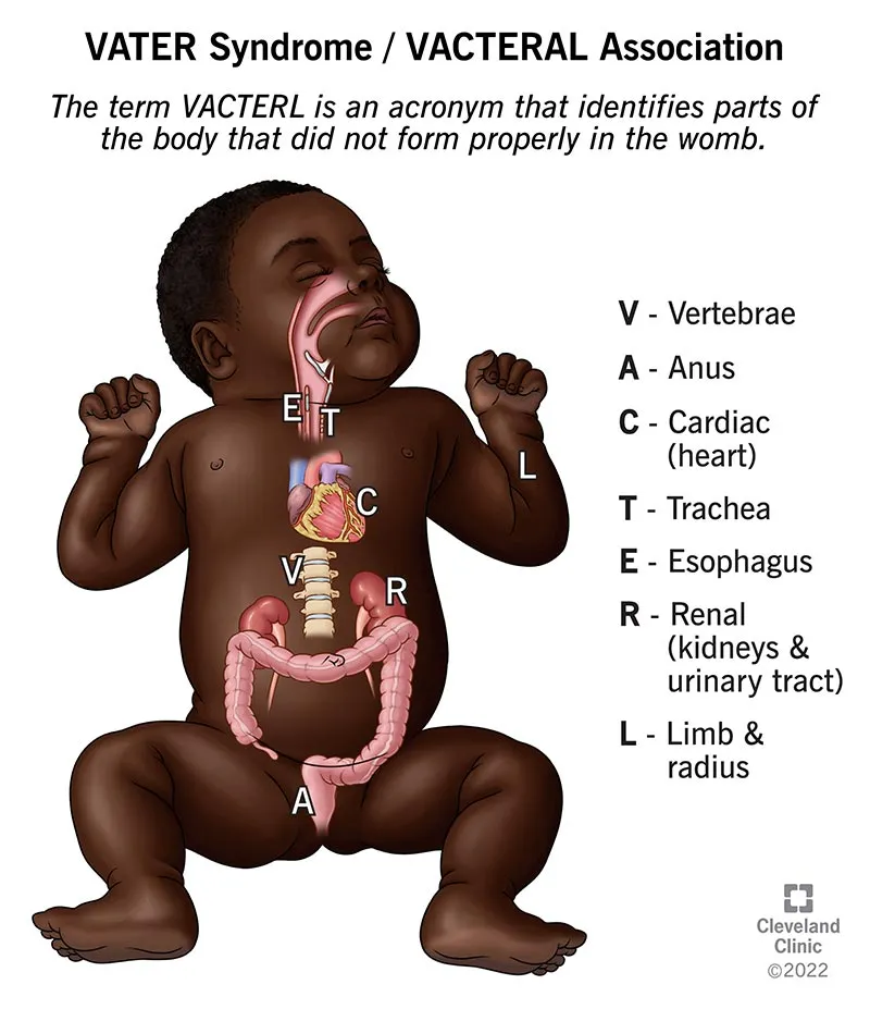 VACTERL association and developmental field defects