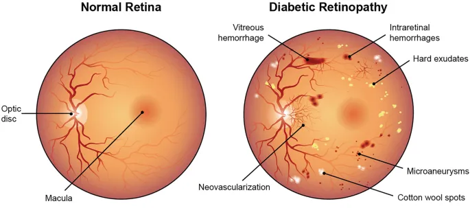 Figure 1: Fundus photograph showing cotton wool spots, microaneurysms, and dot-blot haemorrhages