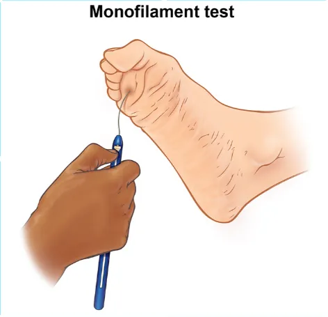 Figure 2: Monofilament testing on plantar surface of foot showing pressure application technique
