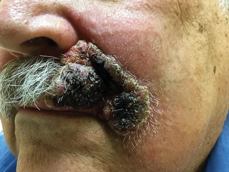 Clinical photograph showing characteristic skin lesions of blastomycosis