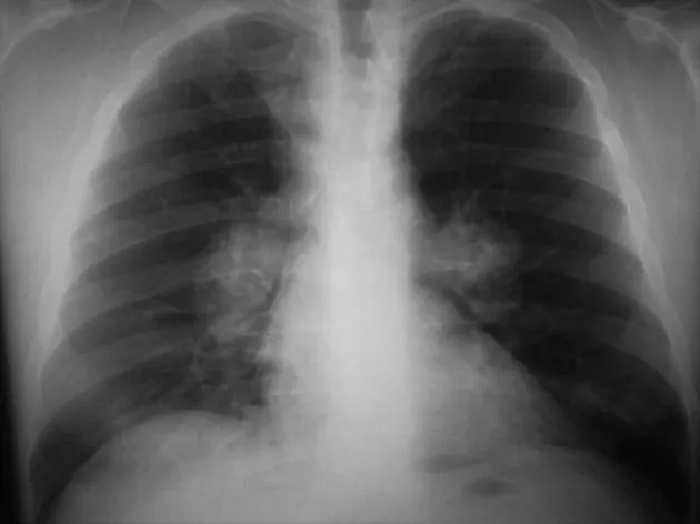 Chest X-ray showing bilateral hilar lymphadenopathy in histoplasmosis