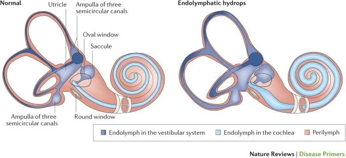 Diagram showing endolymphatic hydrops in Ménière's disease with distended membranous labyrinth