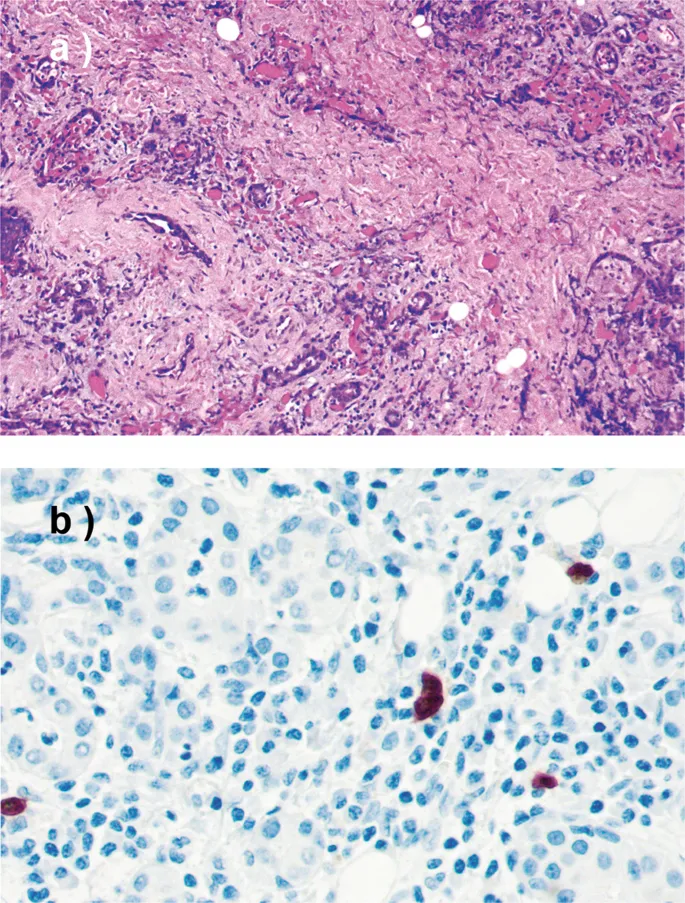 Histopathological comparison of normal vs inflamed salivary gland tissue