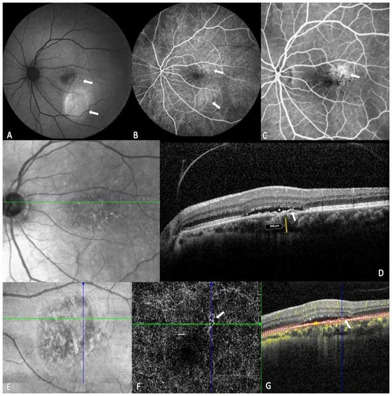 Multimodal imaging showing correlation between fundus photography, OCT, and angiography