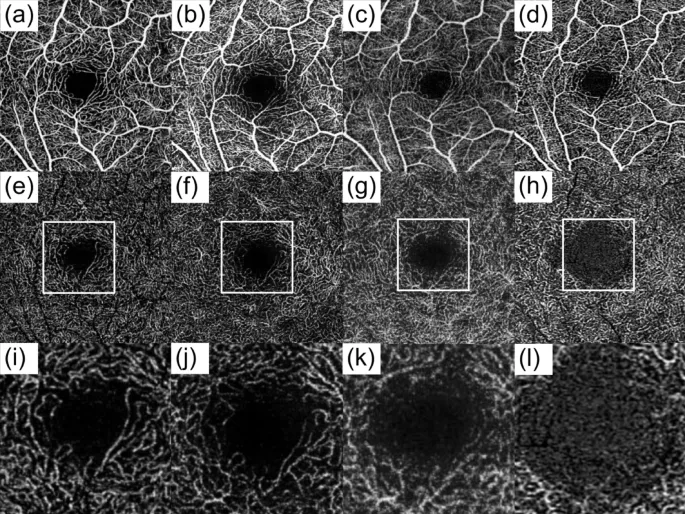 OCT angiography showing retinal capillary networks in superficial and deep layers