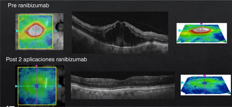 OCT showing resolution of macular edema after anti-VEGF treatment