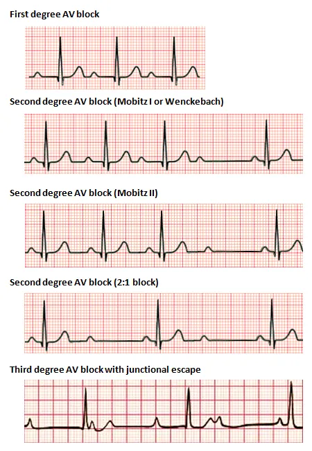 AV block progression showing first degree Mobitz I and Mobitz II patterns