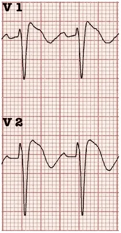 Brugada syndrome ECG showing characteristic coved ST elevation pattern