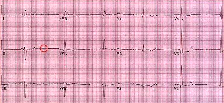 Complete heart block ECG showing AV dissociation with independent P and QRS