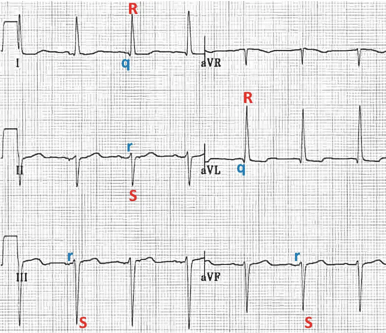 Left anterior fascicular block ECG showing left axis deviation pattern