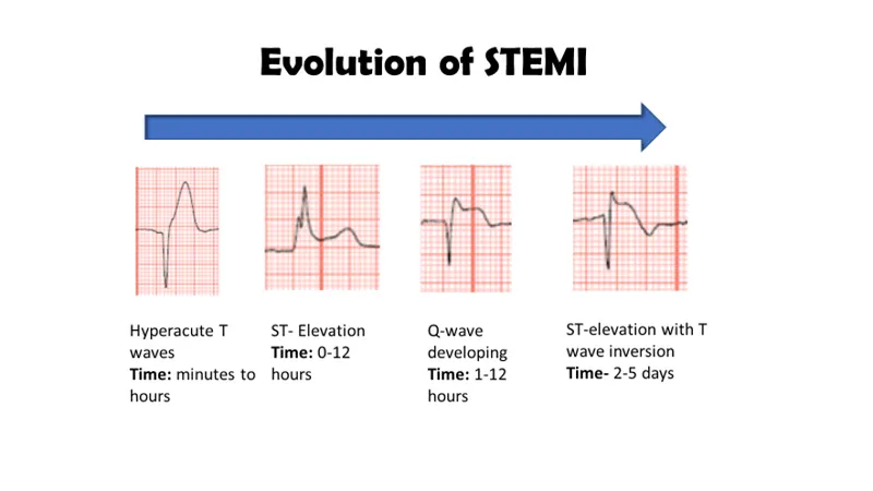 T wave morphology variations showing normal hyperacute and inverted patterns