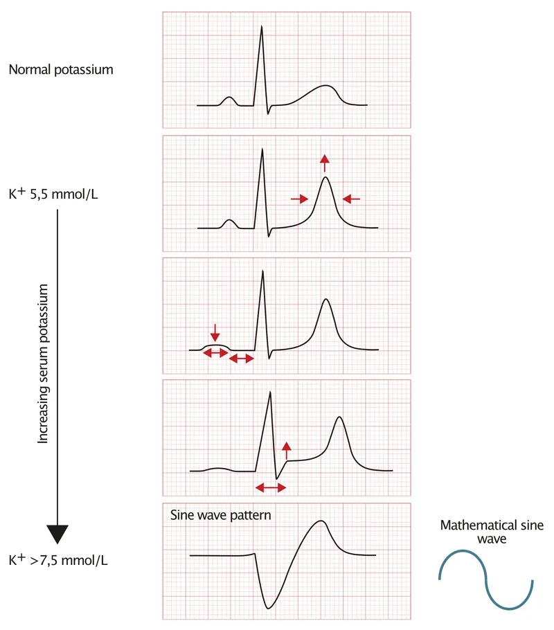 Figure 1: ECG showing tall tented T waves and widened QRS complex in hyperkalaemia
