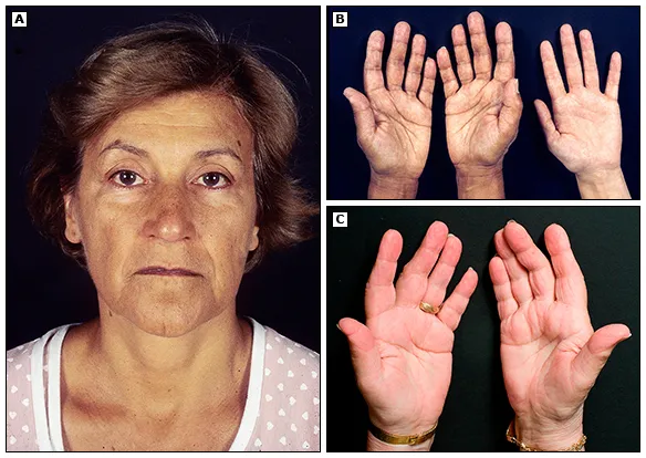 addison disease hyperpigmentation