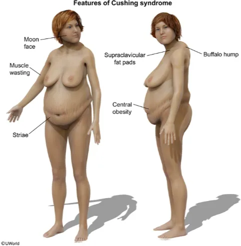 cushing syndrome clinical features