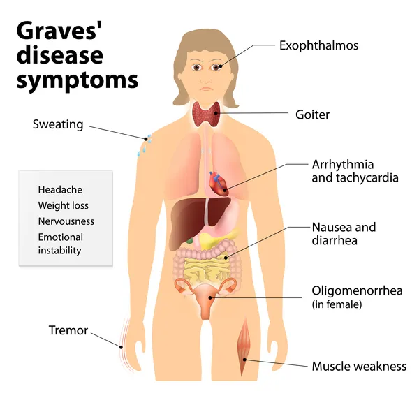 graves disease pathophysiology