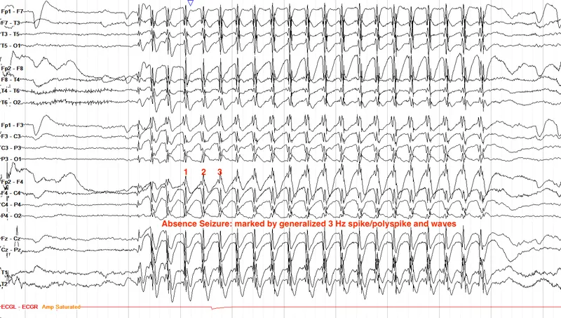 Figure 1: EEG showing 3Hz spike-and-wave pattern characteristic of childhood absence epilepsy