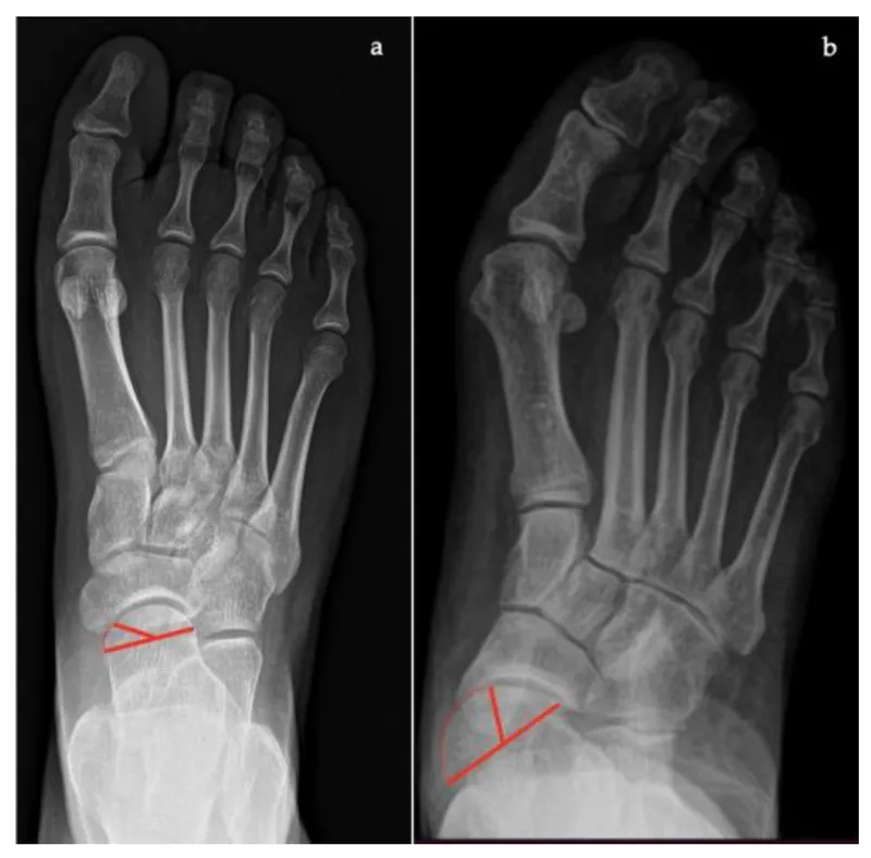 Quick reference surgical measurement guide for foot and ankle procedures