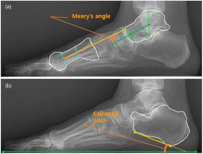 Lateral view X-ray showing normal foot arch alignment and bone relationships