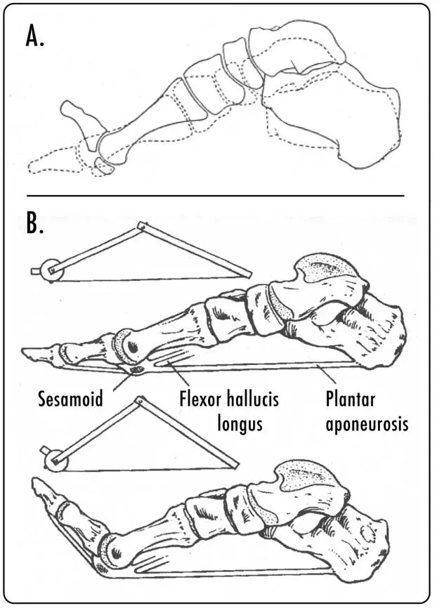 Anatomical diagram showing windlass mechanism with plantar fascia tension