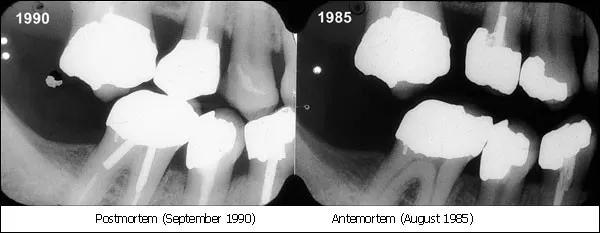 Side-by-side comparison of ante-mortem and post-mortem dental radiographs