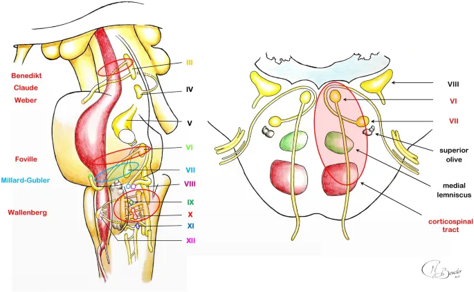 Brainstem syndrome localization showing classic crossed deficit patterns
