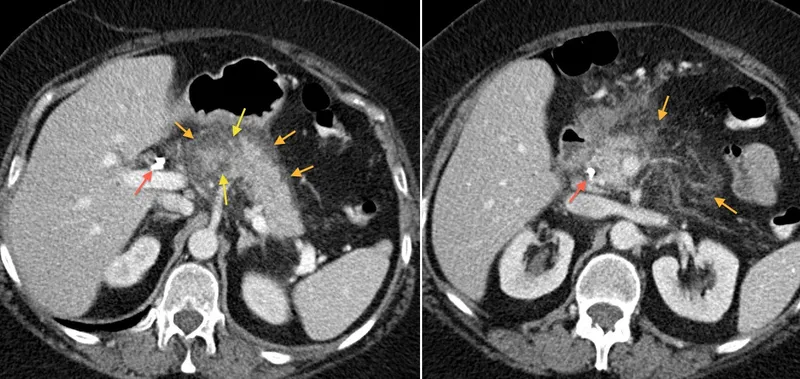 Figure 2: Contrast-enhanced CT abdomen showing pancreatic necrosis with peripancreatic fluid collections and fat stranding