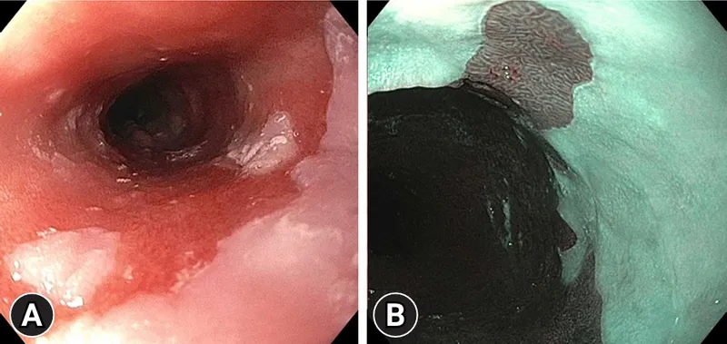 Figure 1: Endoscopic view showing salmon-pink Barrett's mucosa extending proximally from gastro-oesophageal junction