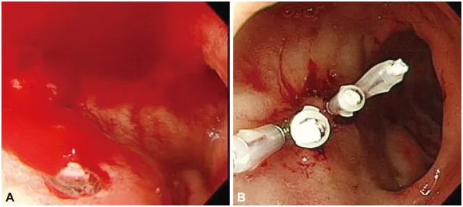 Figure 3: Oesophagogastroduodenoscopy showing spurting arterial bleeding from posterior duodenal ulcer with visible vessel