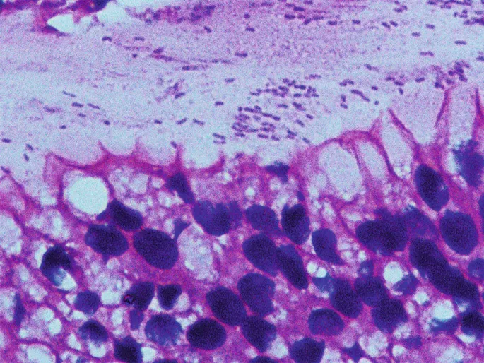 Gastric biopsy showing chronic gastritis with Helicobacter pylori organisms