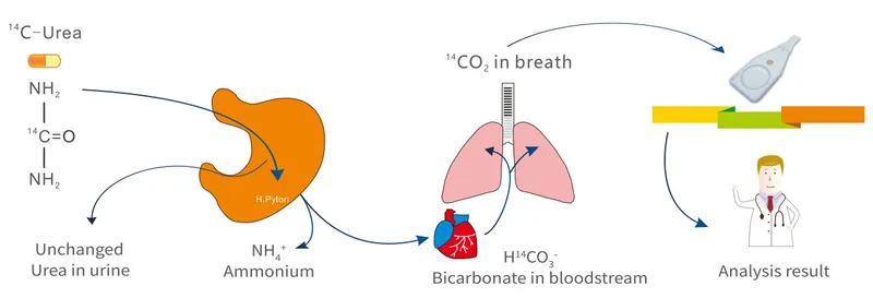 Urea breath test procedure showing patient preparation and sample collection