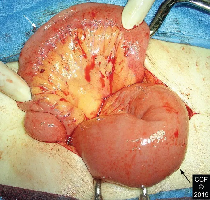 Intraoperative view of adhesive small bowel obstruction showing bowel distension