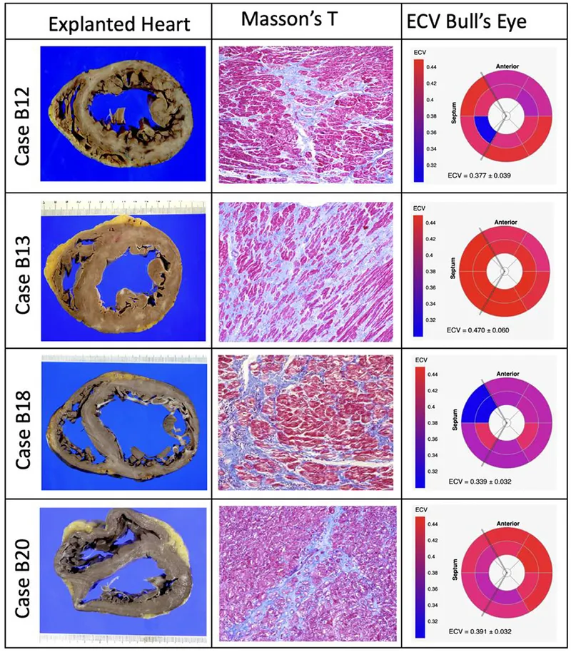 Microscopic view of cardiomyocyte hypertrophy and fibrosis in heart failure