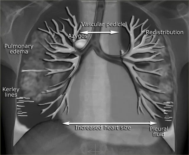 Chest X-ray showing pulmonary edema and cardiomegaly in heart failure