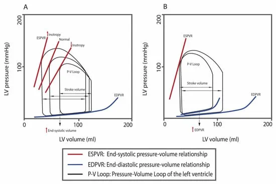 Pressure-volume loops comparing normal heart, HFrEF, and HFpEF