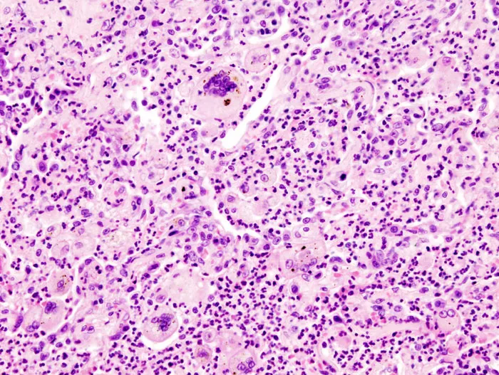 Histological comparison of different granuloma types