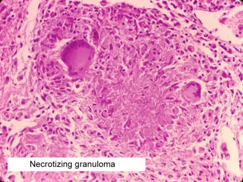 Composite image showing various pathological patterns in tissue sections