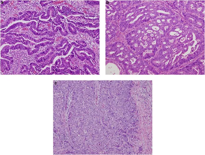 Microscopic images showing different tumor grades and differentiation