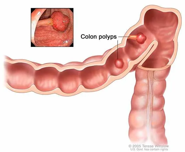 Figure 2: Colonoscopy image showing pedunculated polyp with irregular surface