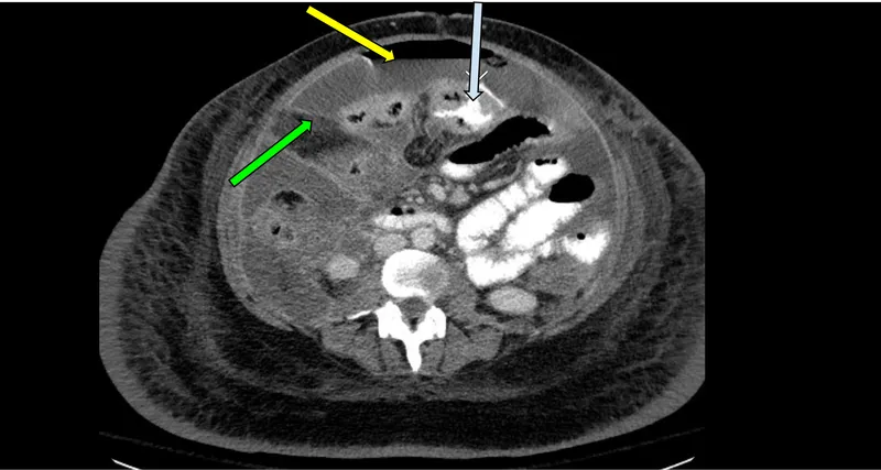 Figure 2: CT scan showing extraluminal gas and fluid with bowel wall discontinuity