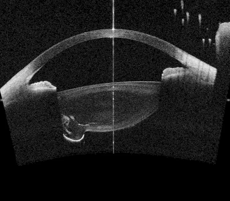 acute angle closure corneal edema