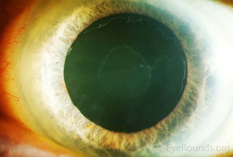 pseudoexfoliation material on lens