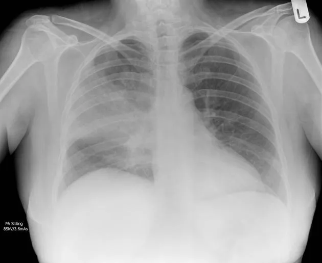 Chest X-ray showing pneumococcal pneumonia with consolidation